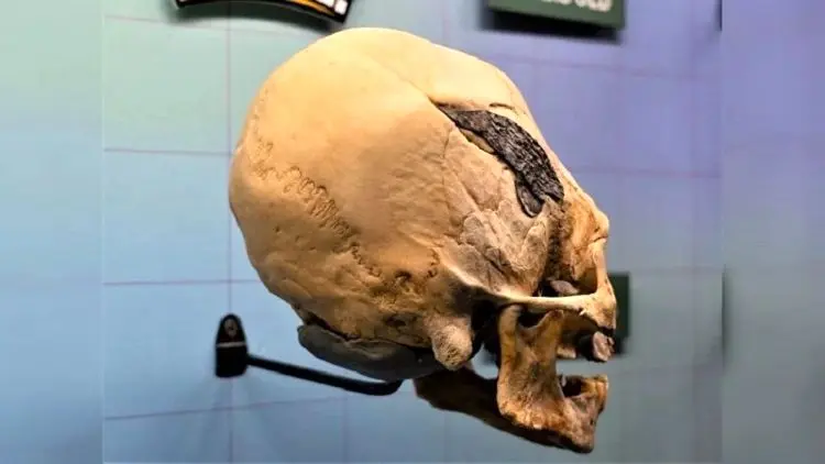  کشف جمجمه‌ای مرموز با یک ایمپلنت فلزی + عکس