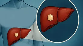 پیگیری دوره‌ای کیست کبدی؛ چند وقت یک‌بار باید سونوگرافی انجام داد؟