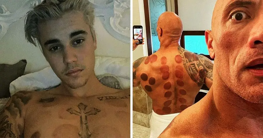 این سلبریتی های هالیوودی از «حجامت» استفاده می کنند
