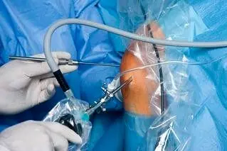 اقداماتی که باید پس از عمل آرتروسکوپی انجام داد!