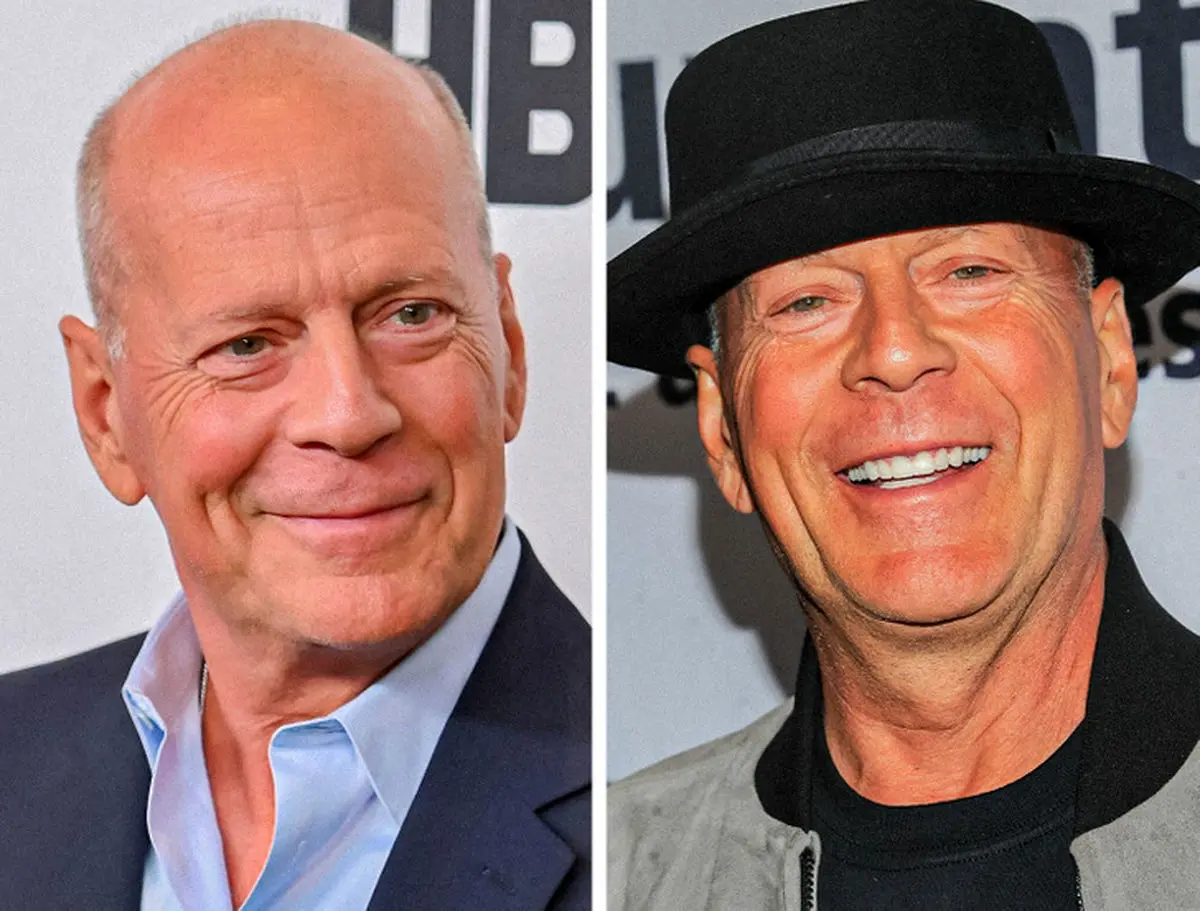 ۱۰ سلبریتی مشهور که به بیماری نادر مبتلا هستند