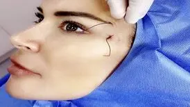 زیبایی روی بند نخ!فلج شدن به سبک لیفت
