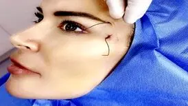 زیبایی روی بند نخ!فلج شدن به سبک لیفت
