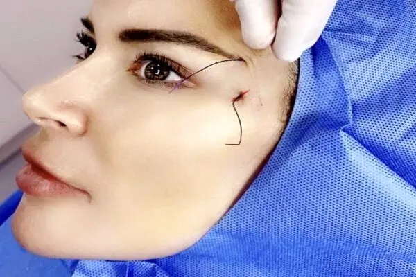 زیبایی روی بند نخ!فلج شدن به سبک لیفت
